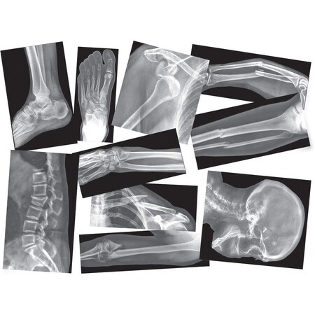 Roylco Broken Bones X-Ray Set, 15 Pieces R5914