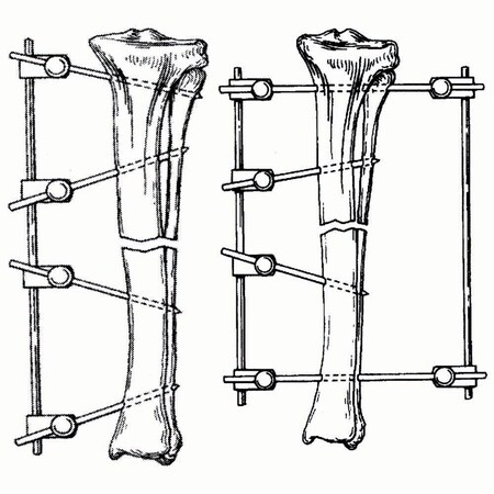 Jorgensen Laboratories Large Fixation Type II Kit, Large IM P", 5/32"x10" Rod, 10"L, 14PK J0371KBL