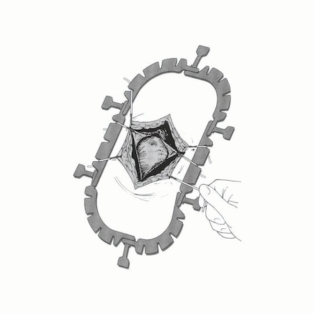 Jorgensen Laboratories The Lone Star Veterinary Retractor System, Ring Retractor Only, Large J4405