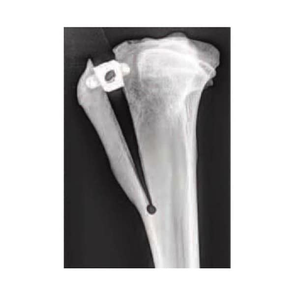 Jorgensen Laboratories 4.5mm x 12mm Titanium TTA Cage with 2.4mm Screw J1072HAT - main