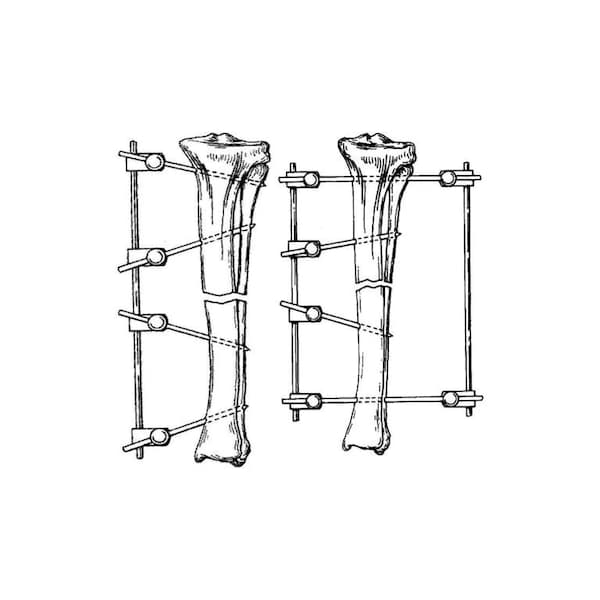 Jorgensen Laboratories Medium Fixation Type II Kit, Medium IM P", 1/8"x9" Rod, 8"L, 14PK J0371KBM - main