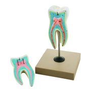 Eisco Scientific Upper Triple Root Molar w/Caries Model, Enlarged 15 Times, 2 Parts AM0046